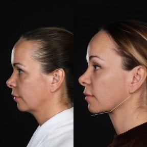 Результаты до и после подтяжки шеи в клинике Vidnova – улучшенный контур шеи и челюсти