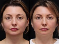 نتائج قبل وبعد شد الوجه العميق في عيادة Vidnova – تجديد شباب الوجه