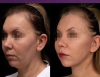 Resultados antes y después de deep plane facelift en Vidnova Clinic – rejuvenecimiento facial visible