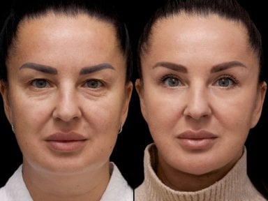 نتائج شد الوجه العميق قبل وبعد في عيادة Vidnova – تجديد شباب الوجه واضح