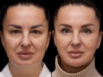 نتائج شد الوجه العميق قبل وبعد في عيادة Vidnova – تجديد شباب الوجه واضح