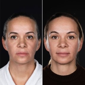 Resultados antes y después de lifting facial profundo en Vidnova Clinic – rejuvenecimiento facial