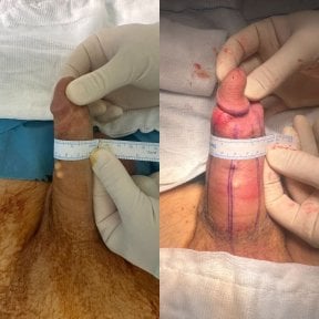 before-after photo penis-filler