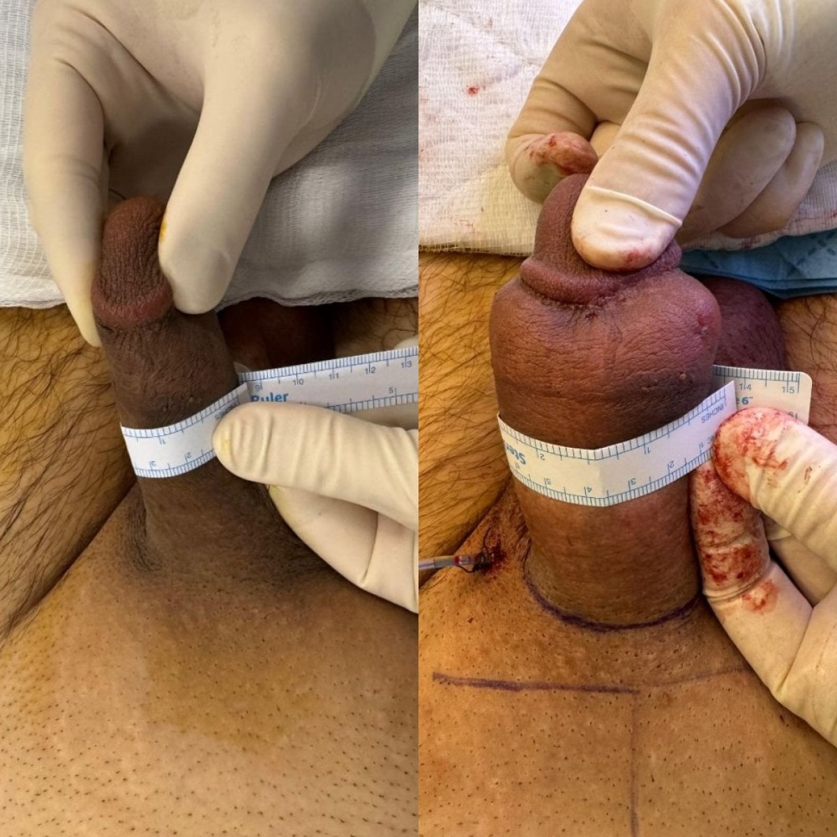 Resultados antes y después de relleno de pene en Uroaesthetic – aumento visible de grosor
