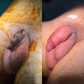 before-after photo penis-enlargement