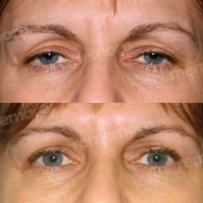 Before and after lower eyelid blepharoplasty results at Memorial Ankara Hospital, eye rejuvenation