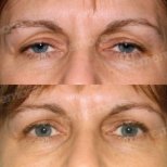 Before and after lower eyelid blepharoplasty results at Memorial Ankara Hospital, eye rejuvenation