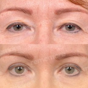 Before and after lower eyelid blepharoplasty results at Memorial Ankara Hospital, rejuvenated eyes