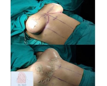 Before and after breast lift with round implants at Dr. MED – visible contour improvement result