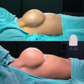 Before and after breast augmentation results at Dr. MED – enhanced breast shape and volume