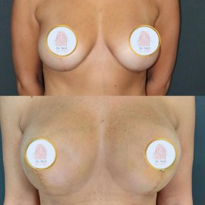 Before and after breast augmentation results at Dr. MED, enhanced breast shape and volume
