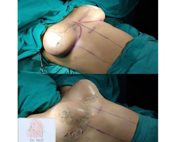 Before and after breast augmentation results at Dr. MED clinic, enhanced breast contour