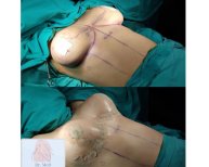 Before and after breast augmentation results at Dr. MED clinic, enhanced breast contour