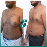 Before and after male gynecomastia surgery results at Soraca Med, chest contour improved