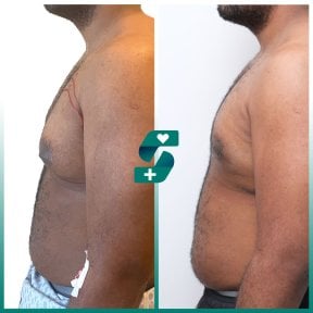 Before and after tummy tuck results at Soraca Med, visible abdominal contour improvement