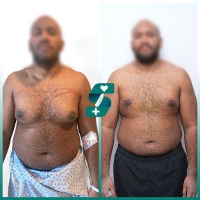 Before and after tummy tuck results at Soraca Med, visible abdominal contour improvement