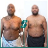 Before and after tummy tuck results at Soraca Med, visible abdominal contour improvement