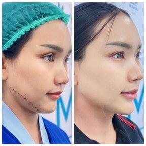Before and after chin liposuction results at Munare Clinic – improved jawline contour