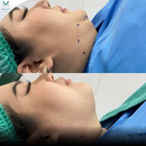 Before and after chin liposuction results at Munare Clinic – improved jawline contour
