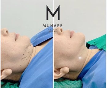 Before and after chin liposuction results at Munare Clinic – improved jawline contour