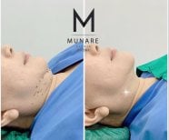 Before and after chin liposuction results at Munare Clinic – improved jawline contour