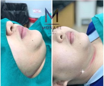 Before and after chin liposuction results at Munare Clinic – improved jawline contour