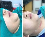 Before and after chin liposuction results at Munare Clinic – improved jawline contour