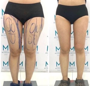 Before and after liposuction of 5 body areas at Munare Clinic, visible thigh slimming result