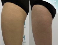 Before and after thigh liposuction results at Munare Clinic, visible contour improvement