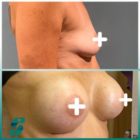 Before and after mammoplasty results at Soraca Med – enhanced breast shape and volume