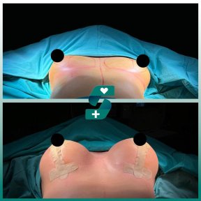 Before and after mammoplasty results at Soraca Med – visible breast augmentation outcome