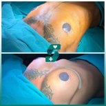 Before and after mammoplasty results at Soraca Med – visible breast augmentation outcome