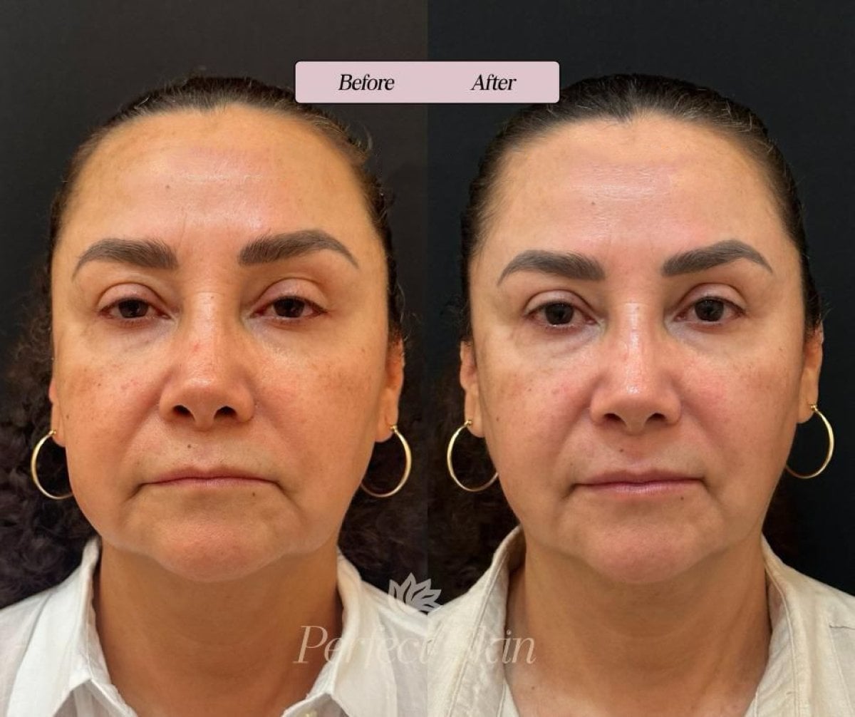 Resultados de Ultherapy antes y después en PERFECT SKIN CANCÚN, mejora de firmeza facial