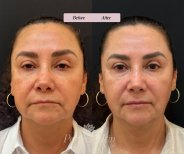 Результаты до и после Ultherapy в PERFECT SKIN CANCÚN, улучшение упругости кожи лица