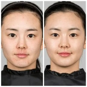 Efekty przed i po infuzji witamin w Wansiri Hospital – jaśniejsza, promienna skóra