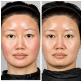 Efekty przed i po infuzji witamin w Wansiri Hospital – poprawa kolorytu skóry twarzy