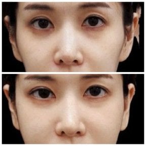 Przed i po infuzji witaminowej w Wansiri Hospital – jaśniejsza, odświeżona skóra twarzy