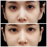 Przed i po infuzji witaminowej w Wansiri Hospital – jaśniejsza, odświeżona skóra twarzy