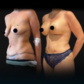 Before and after mammoplasty results at Soraca Med – breast and body contour improvement