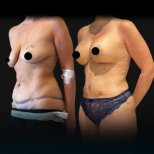 Before and after mammoplasty results at Soraca Med – breast and body contour improvement