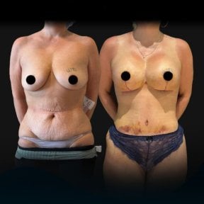 Before and after mammoplasty and tummy tuck results at Soraca Med, visible body contouring