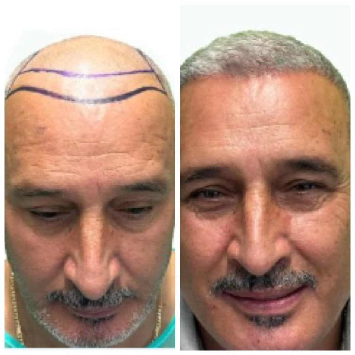 نتائج زراعة الشعر قبل وبعد في Alpha Beauty Hannover، استعادة خط الشعر الطبيعي