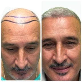 Before and after hair transplant results at Alpha Beauty Hannover, restored natural hairline