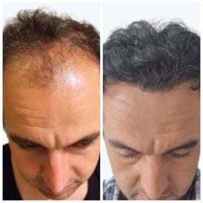 نتائج قبل وبعد علاج تساقط الشعر بالبلازما في Alpha Beauty Hannover، كثافة شعر محسنة