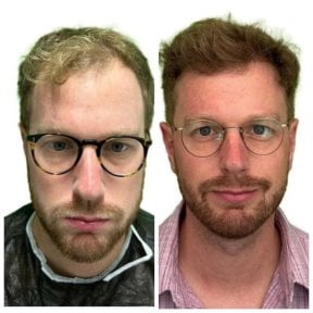 Before and after hair transplant results at Alpha Beauty Hannover, improved hair density