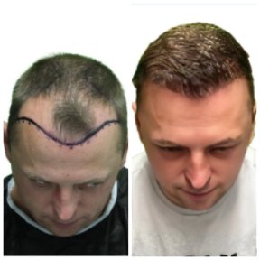 نتائج زراعة الشعر قبل وبعد في Alpha Beauty Hannover، استعادة خط الشعر لدى مريض ذكر