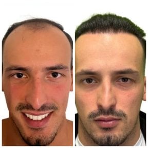 Before and after hair transplant results at Alpha Beauty Hannover, restored hairline in male patient