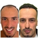 Before and after hair transplant results at Alpha Beauty Hannover, restored hairline in male patient