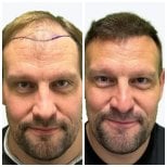 Before and after hair transplant results at Alpha Beauty Hannover – restored fuller hairline