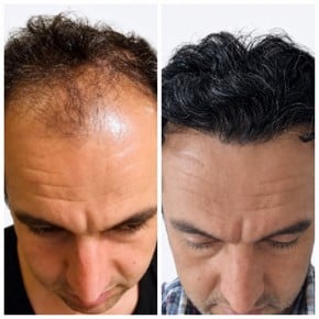 نتائج زراعة الشعر FUE قبل وبعد في Alpha Beauty Hannover، كثافة شعر محسنة